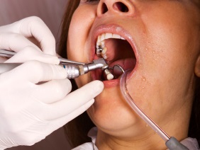 patient with amalgam 2